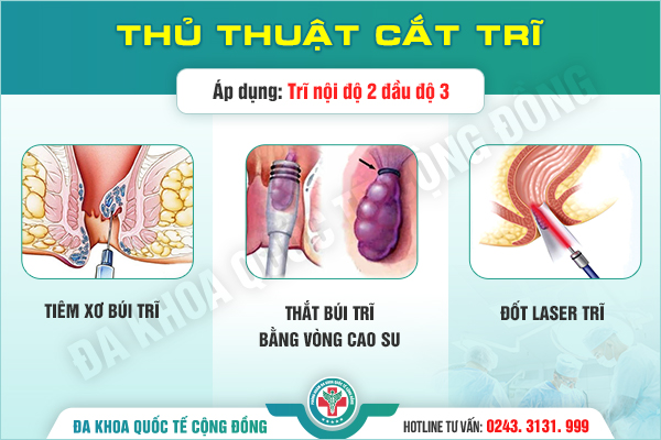 Thắt búi trĩ bằng vòng cao su: Rủi ro nguy hiểm nếu chưa thực sự hiểu rõ