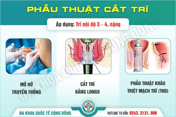 Cắt trĩ bằng Longo: Nhanh gọn, ít đau nhưng có phải tối ưu nhất?