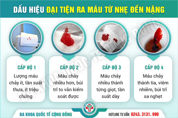 CẢNH BÁO: Những dấu hiệu bệnh trĩ dễ bị bỏ qua – Có thể bạn đang mắc mà không hề hay biết!